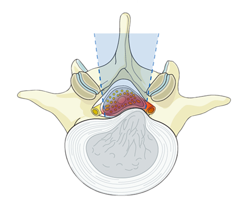 Central Stenosis