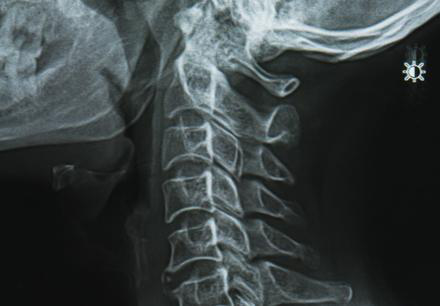 degenerative disc disease