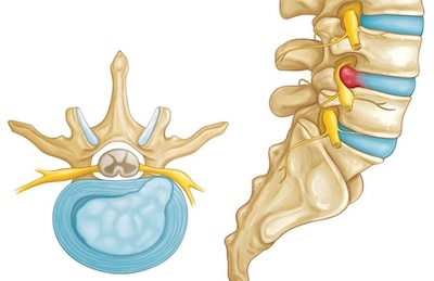 Herniated Disc