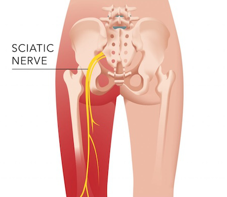 Sciatic Nerve Pain